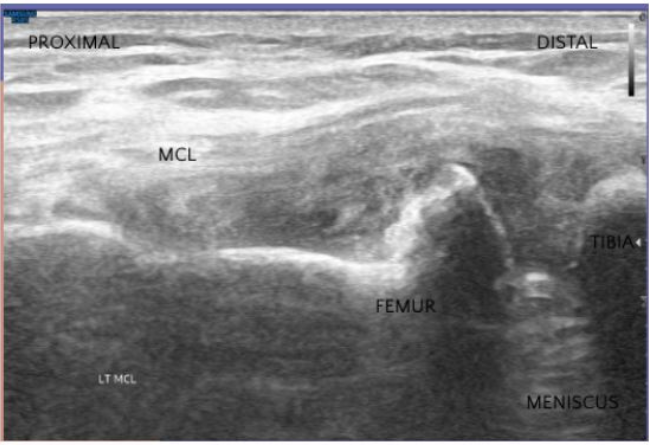 Ultrasound image of medial knee complex including MCL and meniscus
