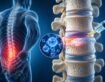 Can Stem Cell Therapy Help Degenerative Disc Disease?