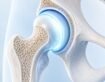 Can Stem Cell Therapy Help Hip Arthritis?